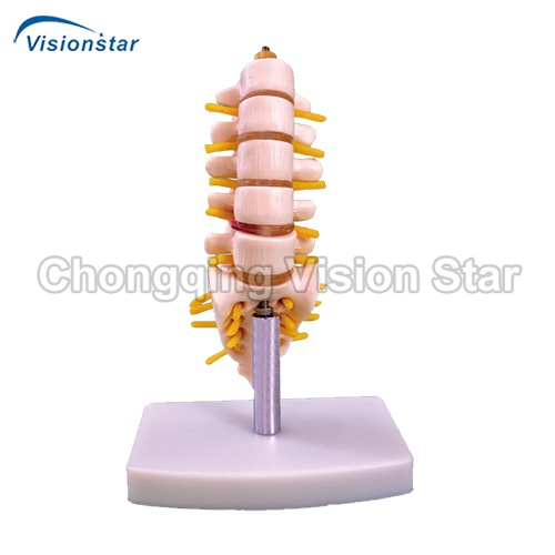 ALM119A Mini Lumbar Vertebrae with Sacrum & Coccyx and Herniated Disc