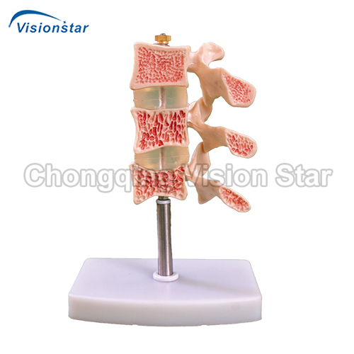 AVC134 Cutaway Osteoporosis